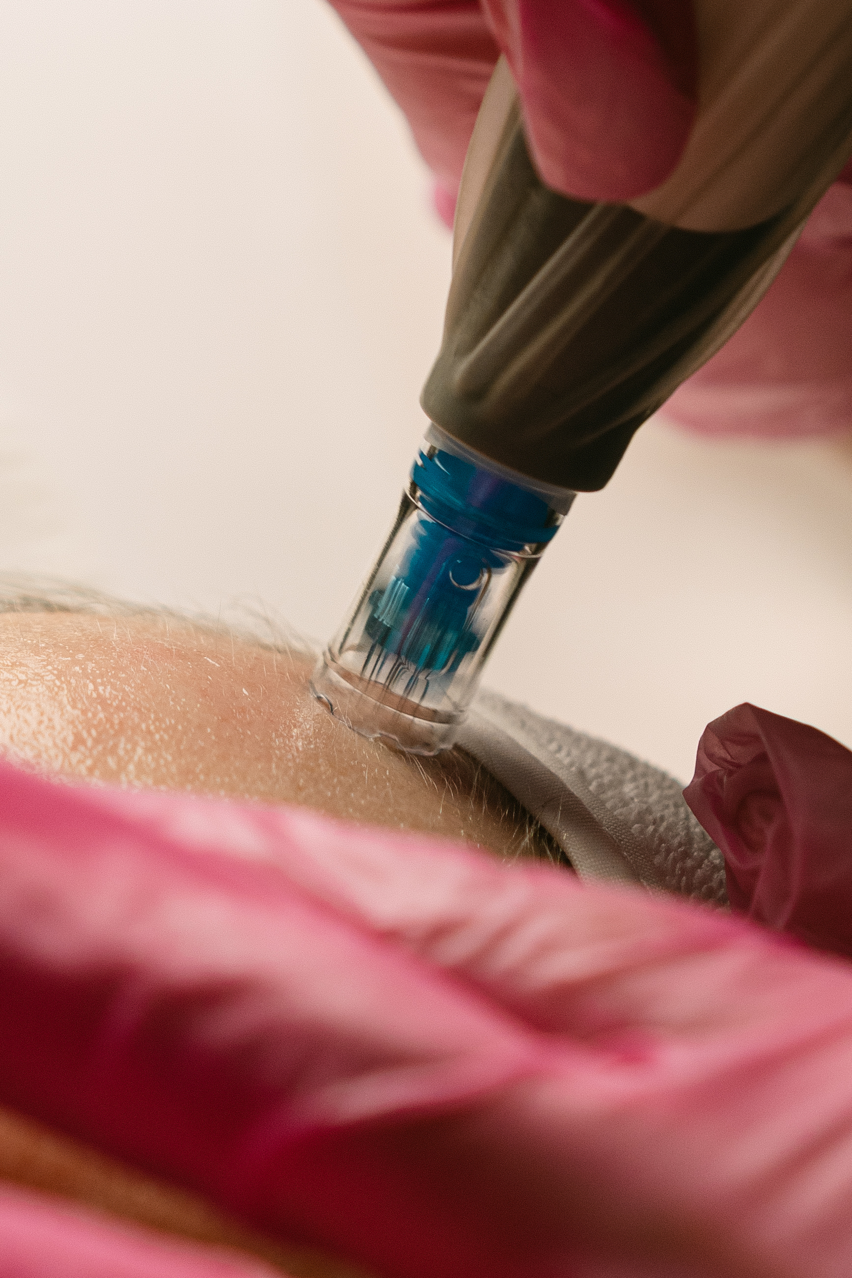 Dermapen Microneedling